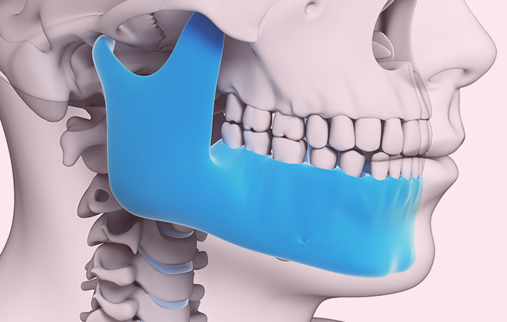 Implant Supported Dentures