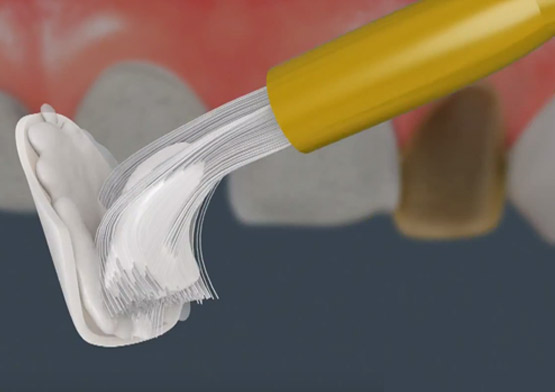 Dental Veneers vs. Lumineers Miami Beach, FL