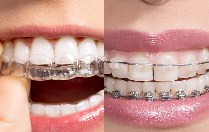 Invisalign Miami Beach, FL