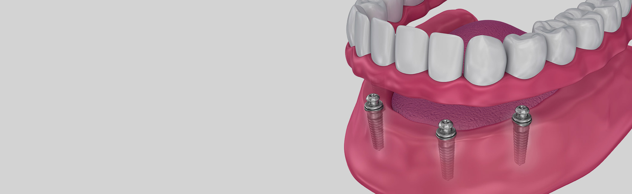 dentures supported by implants Miami Beach FL