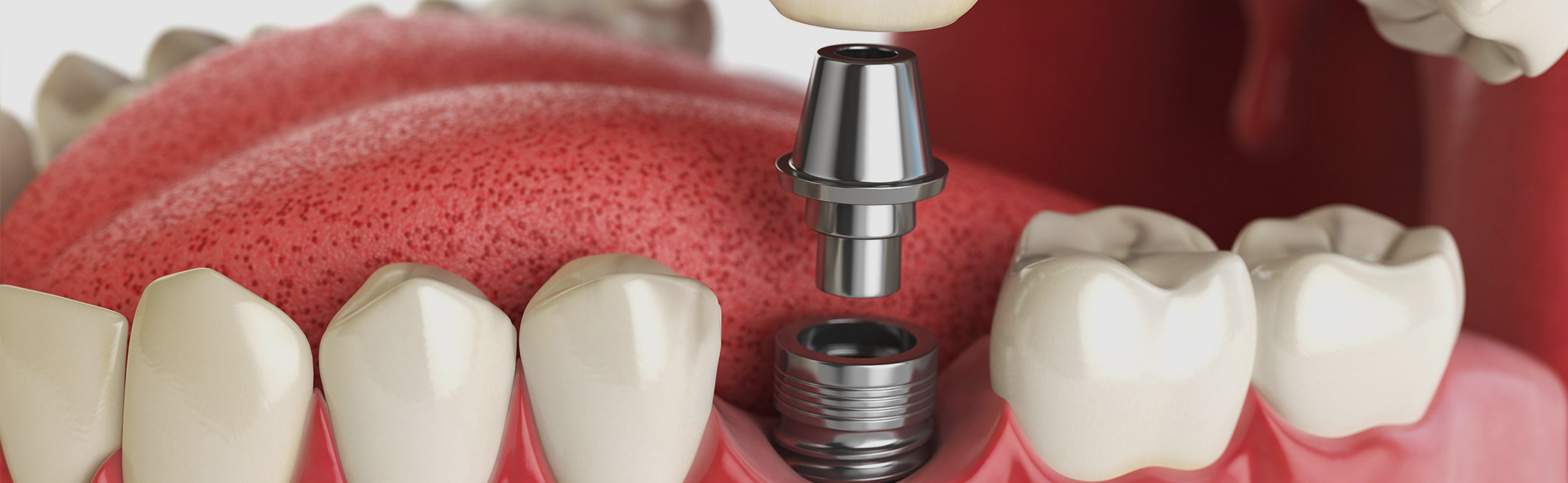 anatomy of dental implant Miami Beach FL