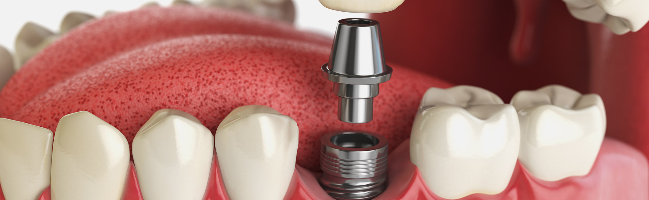 dental implant insertion Miami Beach FL.