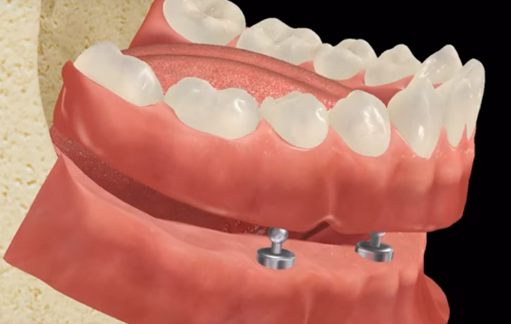 Implant Supported Dentures Miami Beach, FL