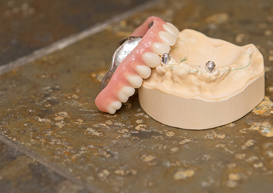 Denture Stabilization Miami Beach, FL