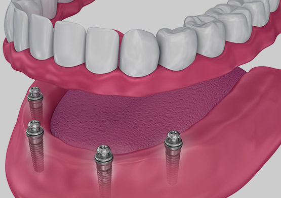 Denture Stabilization Miami Beach, FL