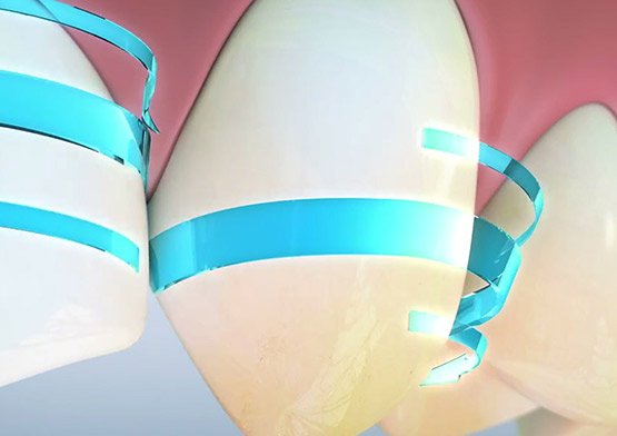 Teeth Whitening Miami Beach, FL