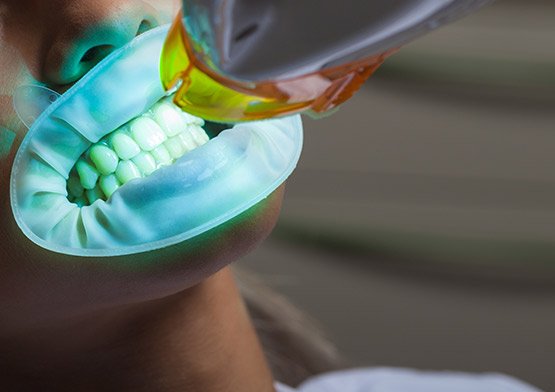 Teeth Whitening Miami Beach, FL