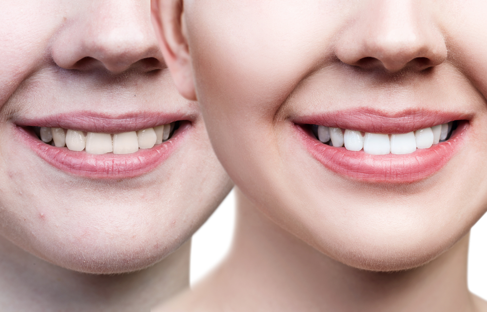 the benefits of choosing professional whitening over at home products