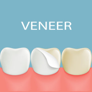 Dental Veneers