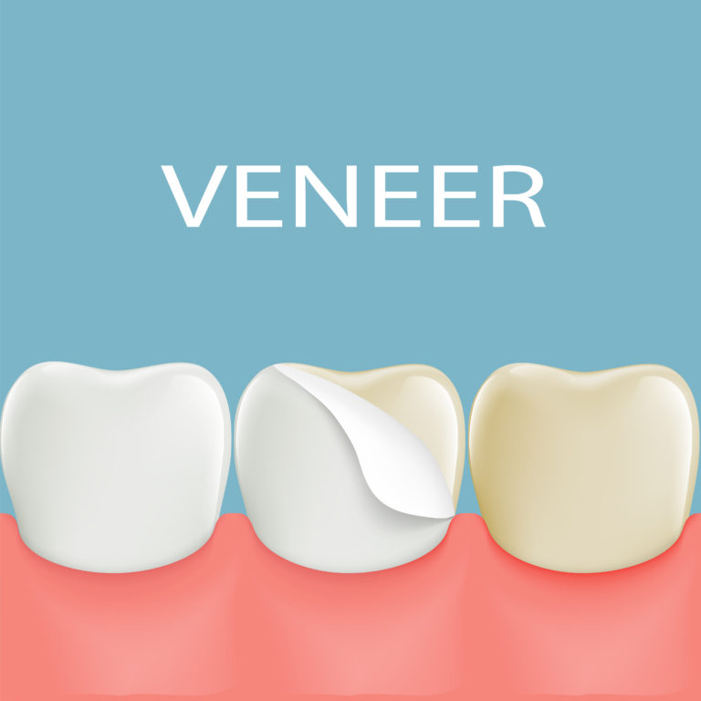 Are Veneers worth it | Dental Implants Miami Beach