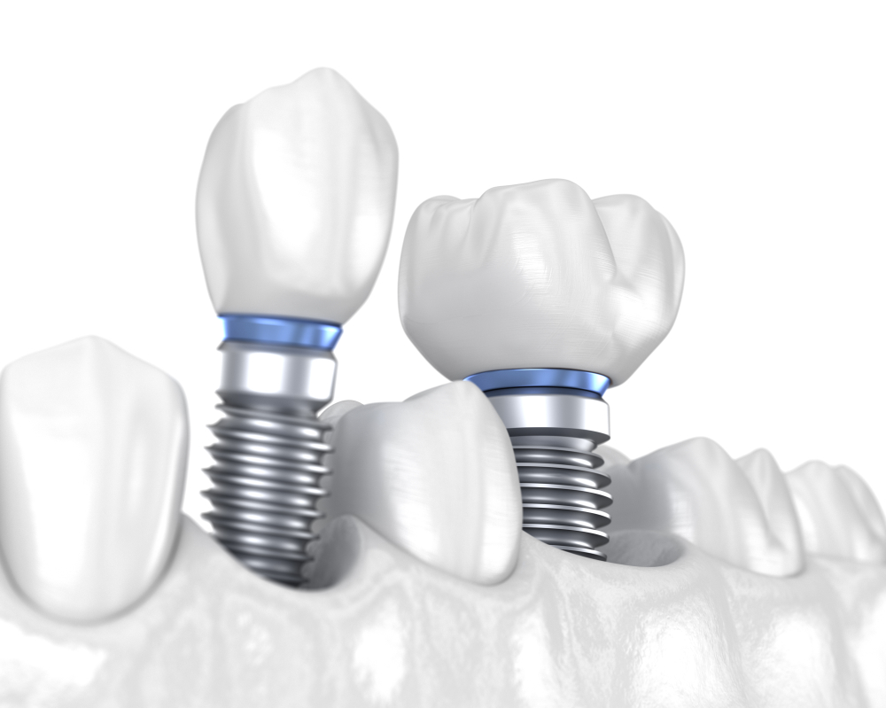 An Introduction to the Dental Implant Procedure