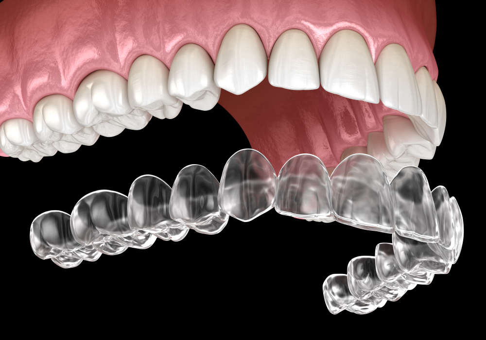 Straighten Your Teeth With Invisalign®