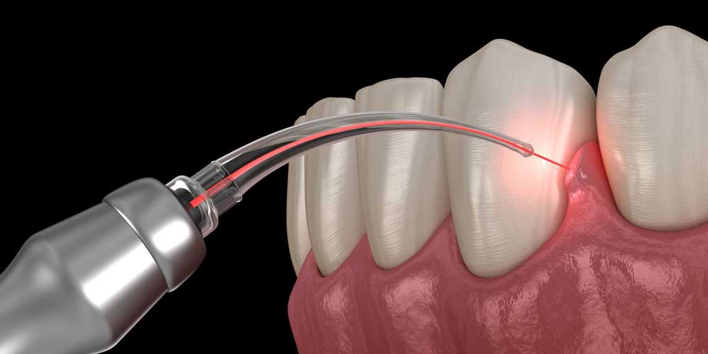 a graphic of laser gum disease treatment