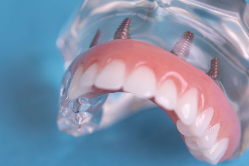 Dental Implant Model