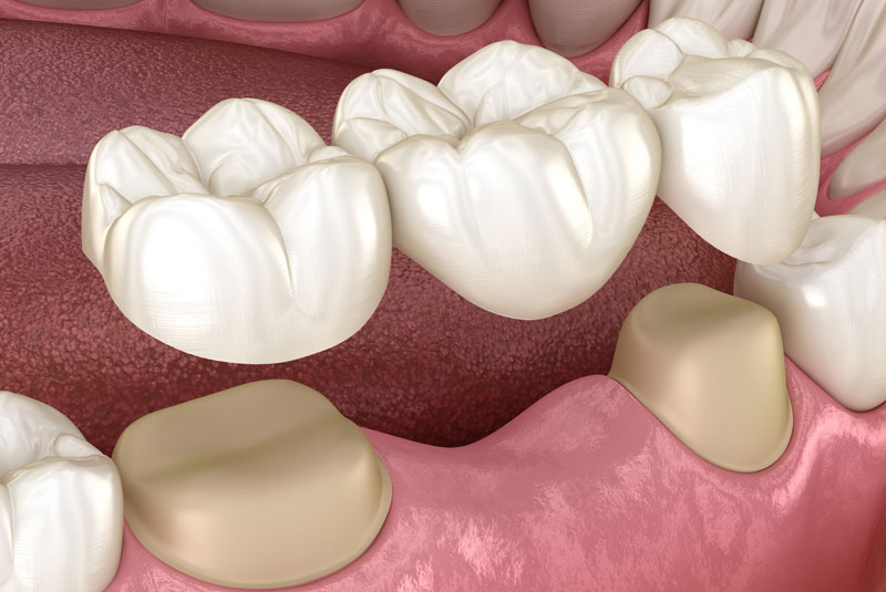 How a Dental Bridge Looks In Your Mouth