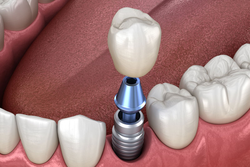 A Dental Implant In Your Mouth