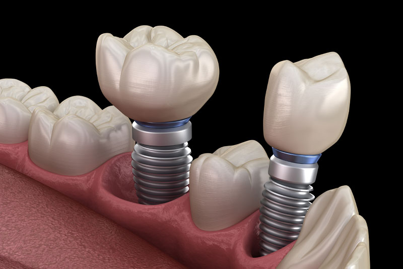 Multiple Dental Implants Model