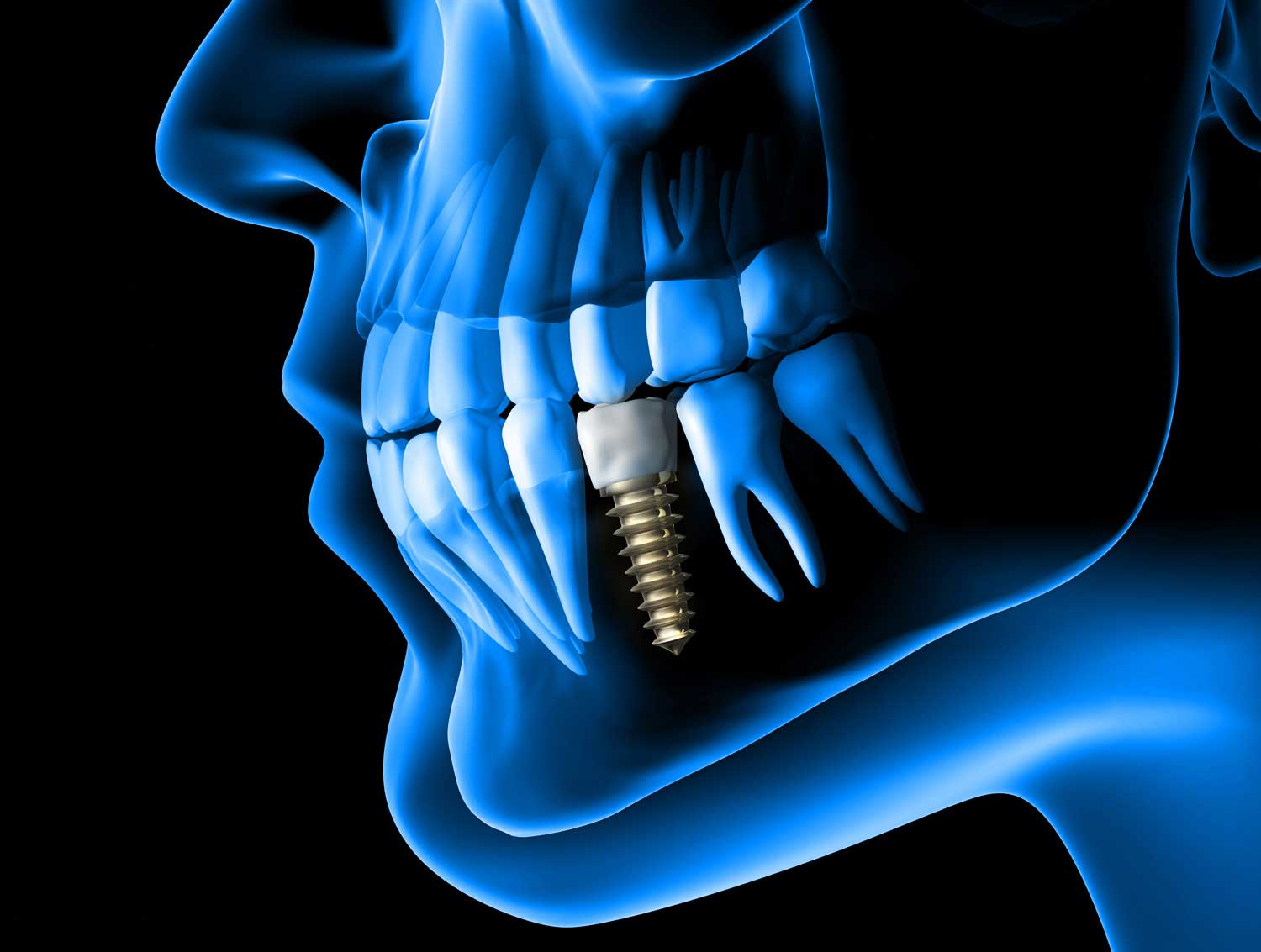 x-ray view of a placed dental implant