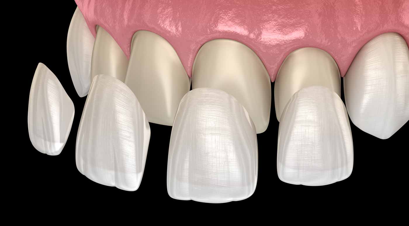 a diagram of porcelain veneers being placed