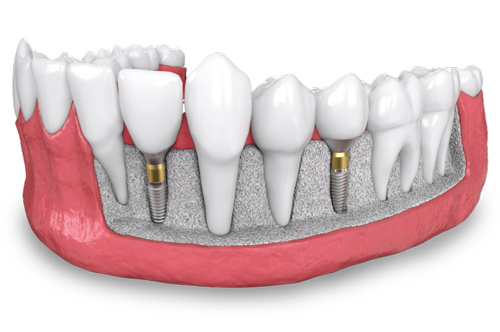a model of two, placed dental implants