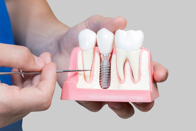 Dental Implants Albany Ny