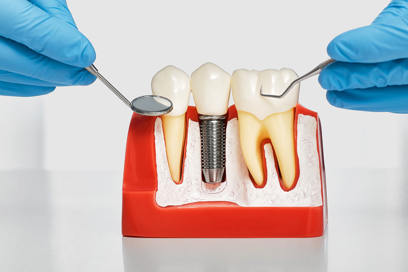 dental implant model bone cutaway showing a single post and dental implant