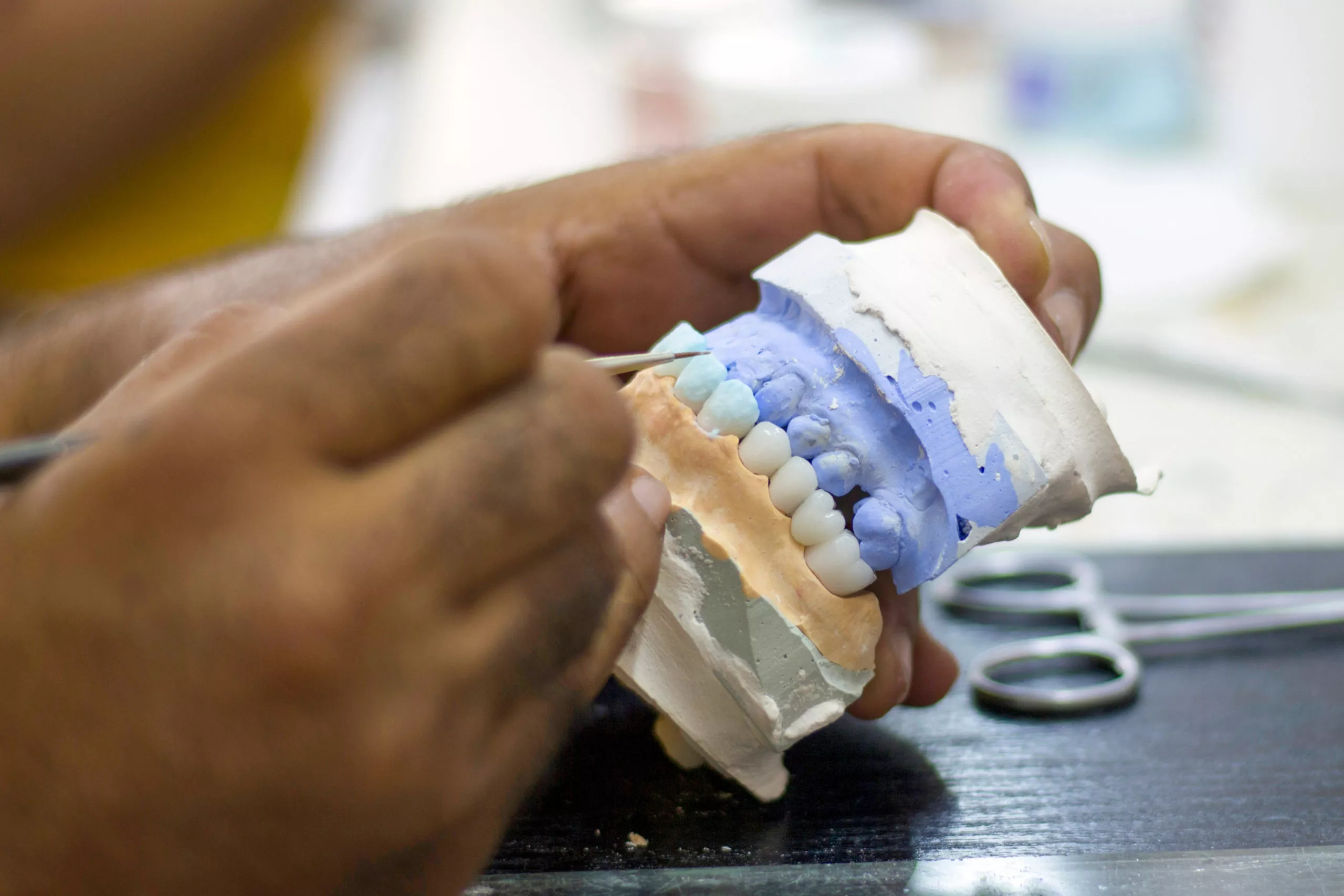 a full mouth dental implant model scaled
