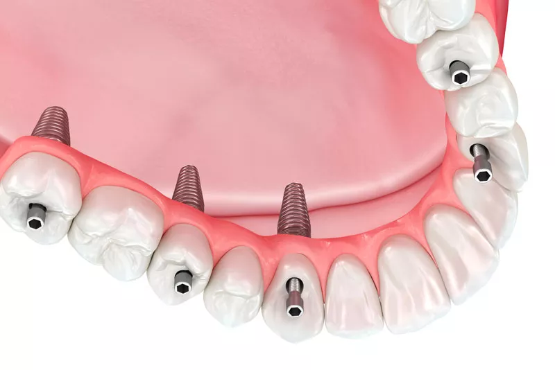 dental implant prosthetic being placed on dental implant posts