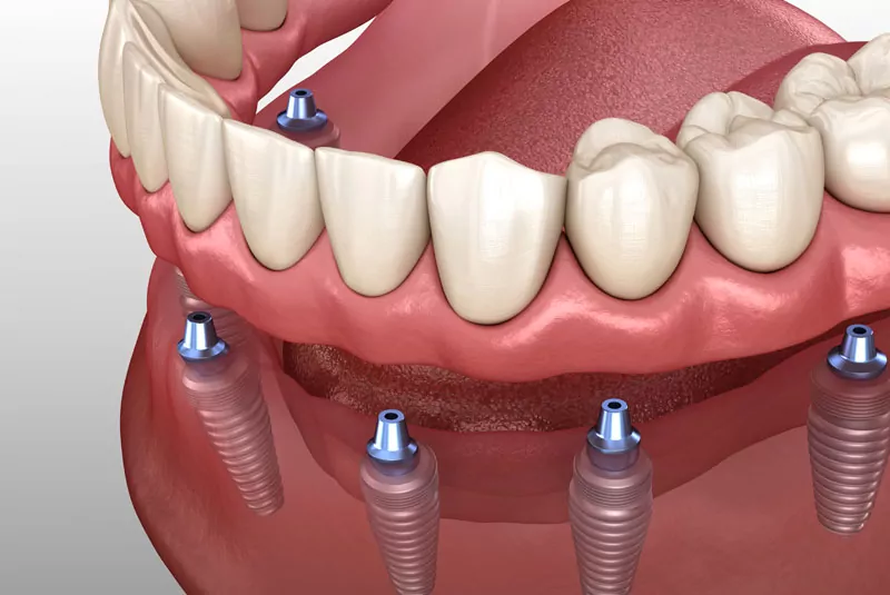 implant supported dentures graphic 1