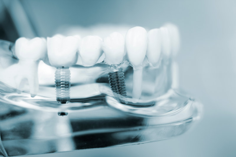 An image of a model showing dental implants.