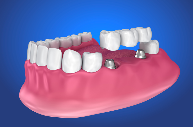Close-up 3d image of a dental implant bridge and a prosthesis jaw with a blue backdrop