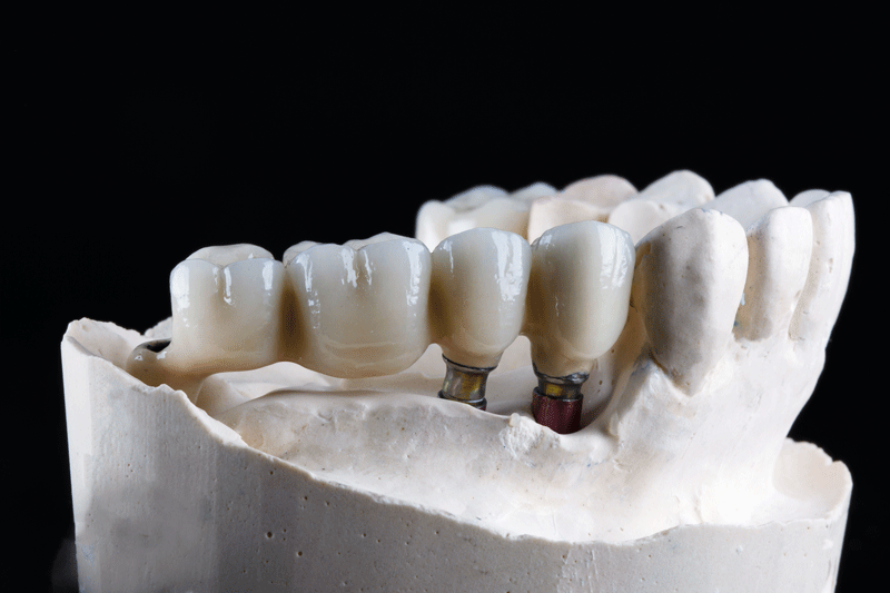 photo of side of dentures showing teeth with two implants