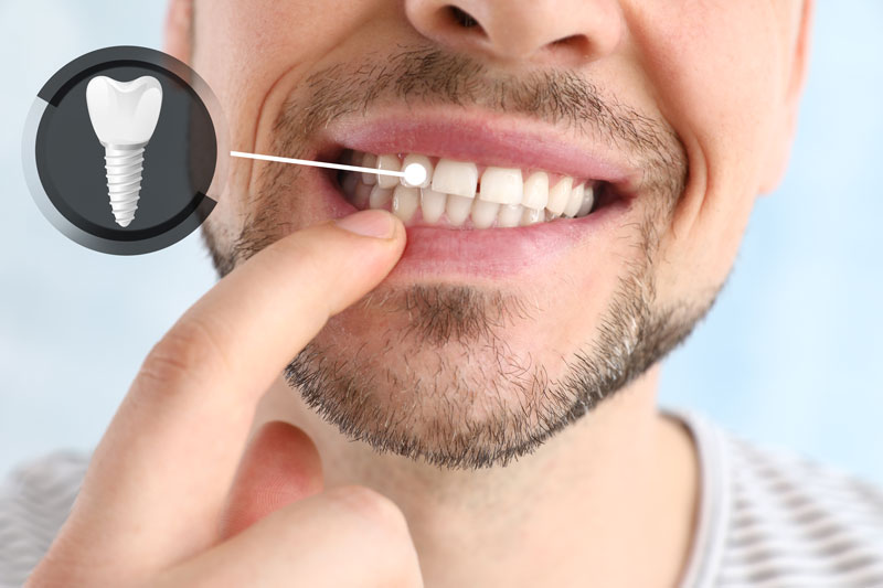 a man pointing to a dental implant.