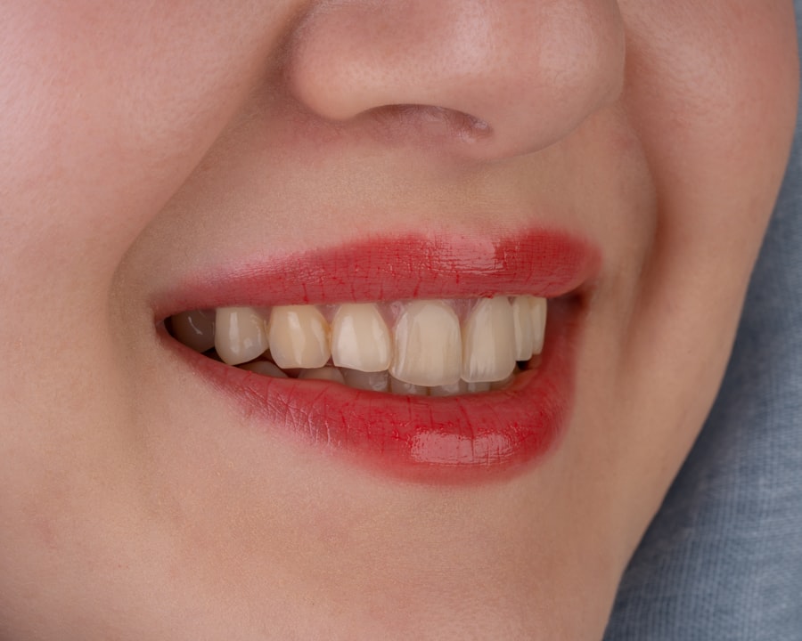 veneers