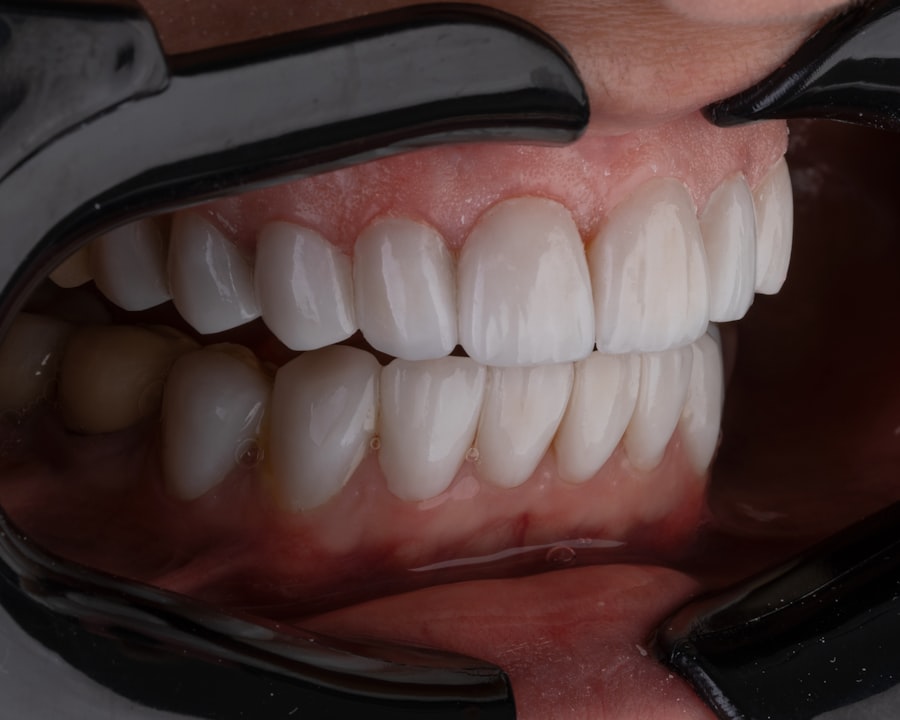 Photo veneers