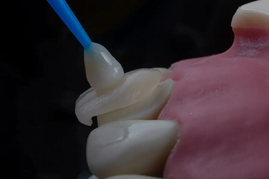 Photo dental bonding