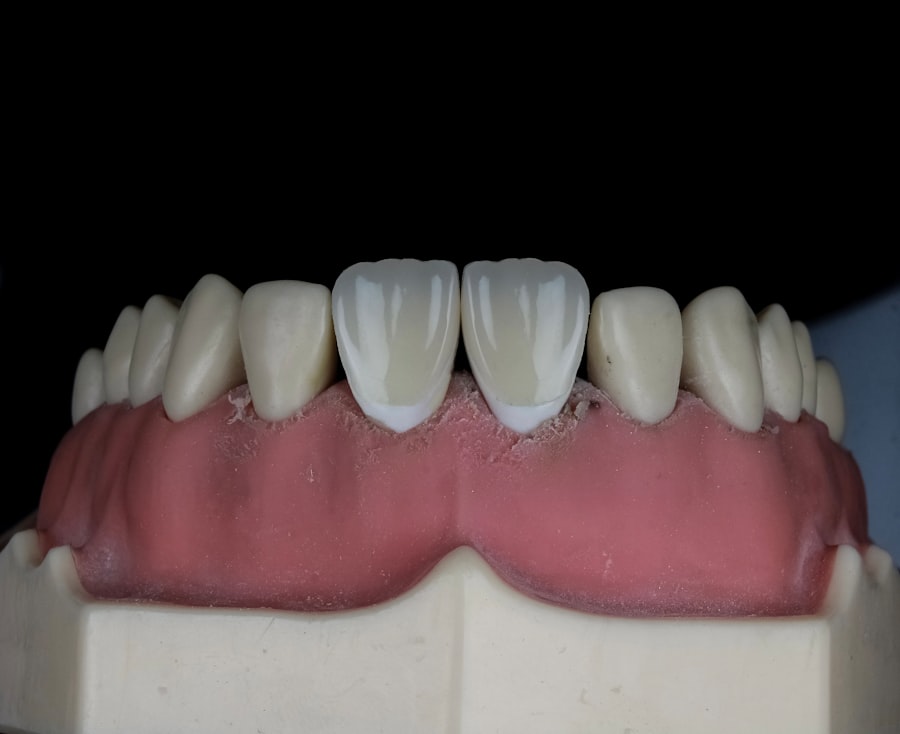 Photo veneers