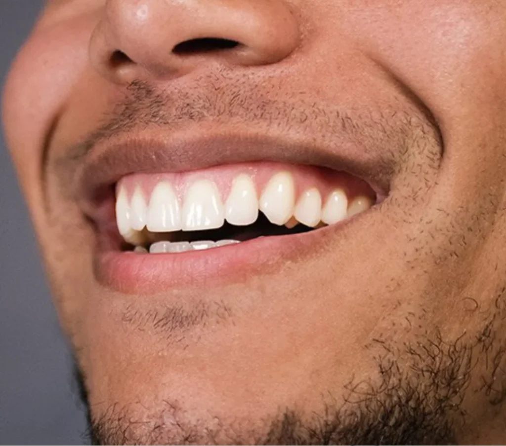 A complete smile makeover.webp