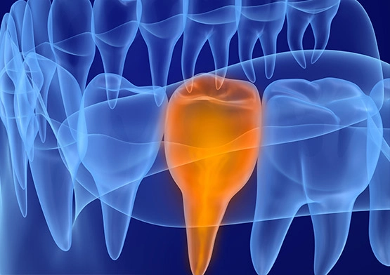 Cosmetic Dentistry Services Available Invisalign® Composite fillings in miami beach florida dentist implants.webp