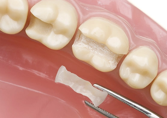 Inlays and overlays in miami florida.webp