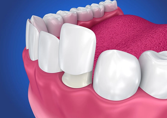 Porcelain veneers in miami florida dentist.webp