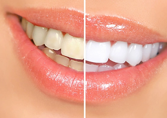 Teeth whitening Invisalign in miami beach florida.webp