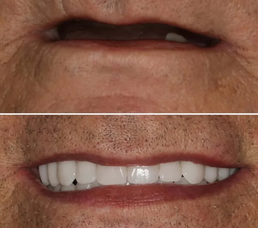 Veneers Implants dentures and more in Miami.webp