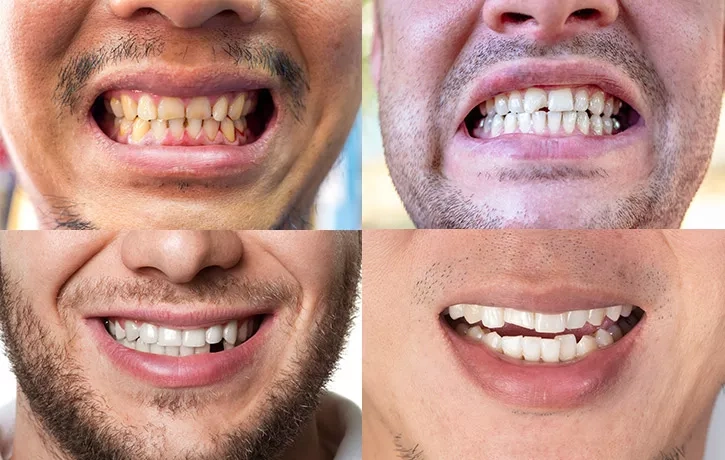 Veneers in miami florida.webp