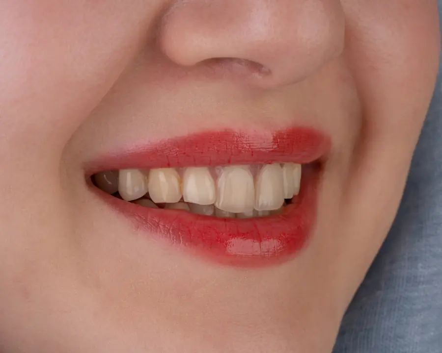 veneers